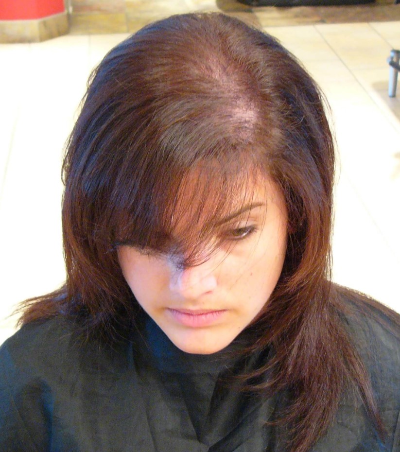 prezgodnje izpadanje las